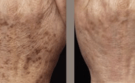 IPL Photofacial