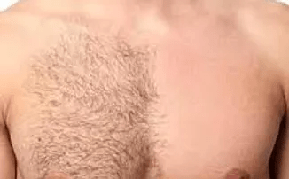 Laser Hair Removal